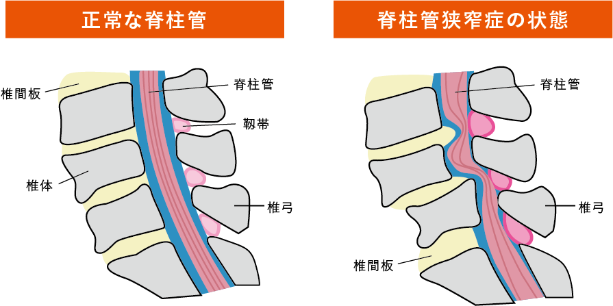 正常な脊柱管 脊柱管狭窄症の状態